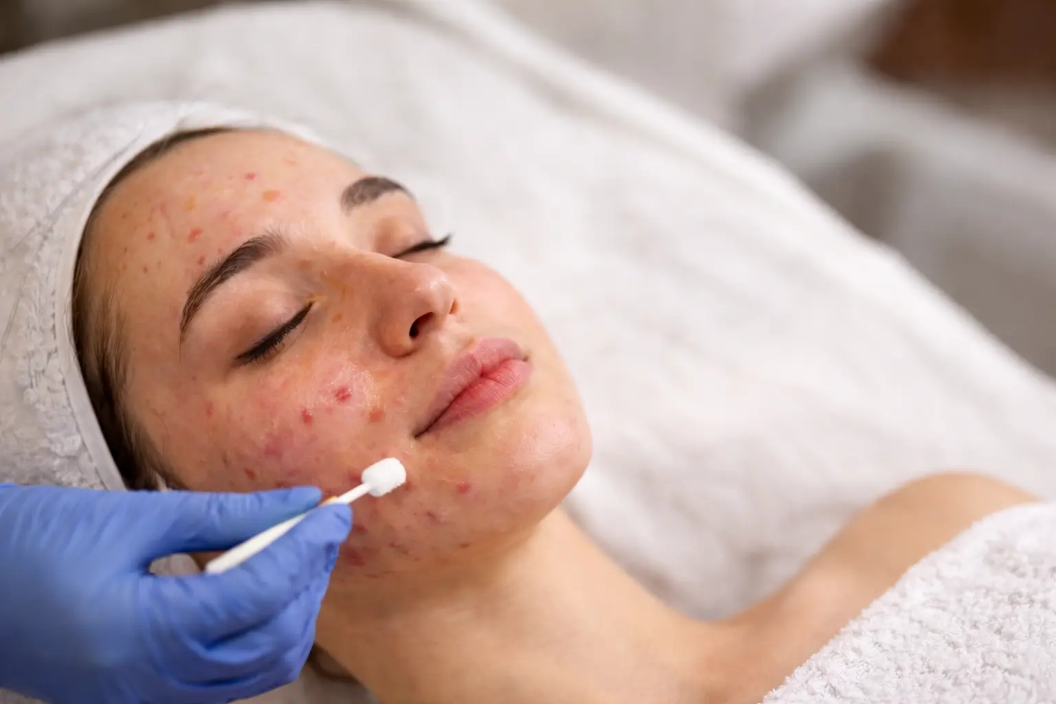 Лікування акне у SM.CLINIC